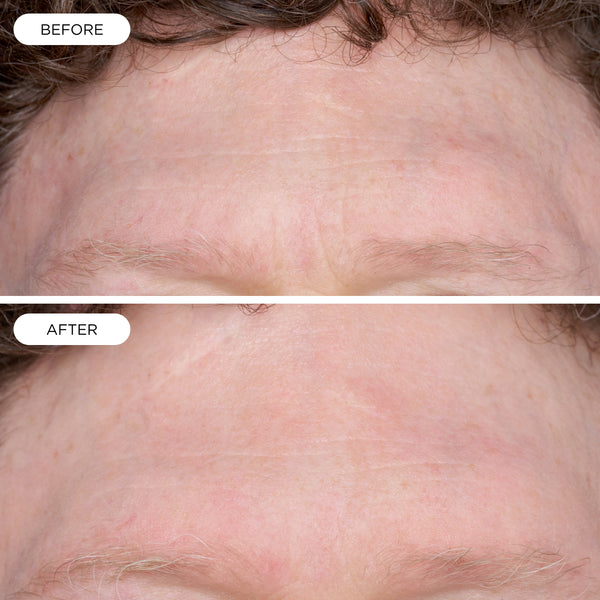 Before and after using Youth Potion Advanced, showing smoother-looking skin and reduced-looking fine lines.